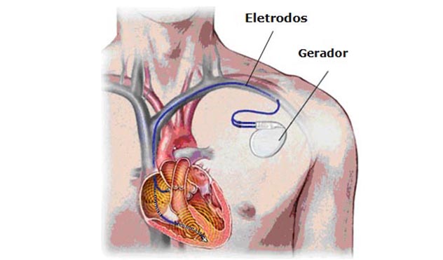 Projeto preserva saúde de pacientes com marca-passo (16/10/2015 00:00:00)